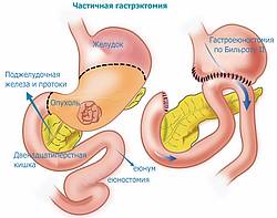 Частичная гастрэктомия