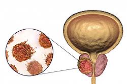 Рак простаты