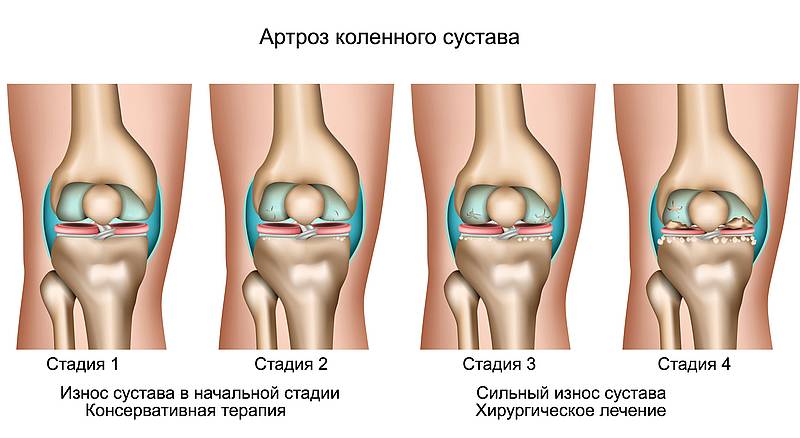 Артроз и замена суставов гарантия упражнения с палкой для восстановления плечевого и локтевого сустава
