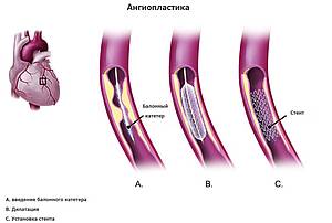 ангиопластика в Германии