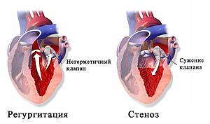 Патологии митрального клапана