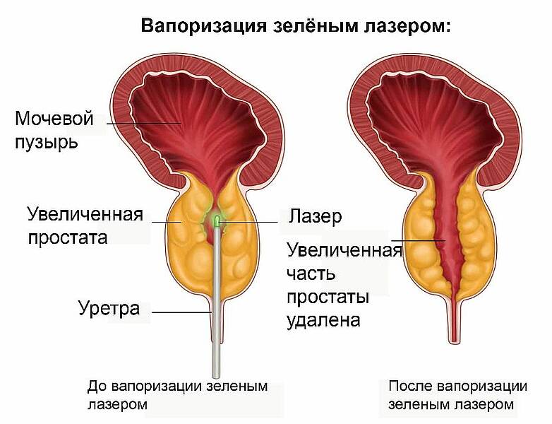 Артерии простаты. Вапоризация аденомы простаты. Трансуретральная резекция предстательной железы. Аденома простаты лазером.