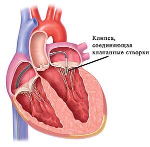 Транскатетерная пластика митрального клапана