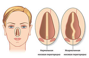 Искревление носовой перегородки