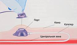 химиотерапия при онкологии в Германии