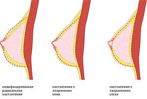мастэктомия в Германии