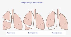 лечение рака легкого в Германии