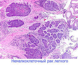 Немелкоклеточный рак легкого