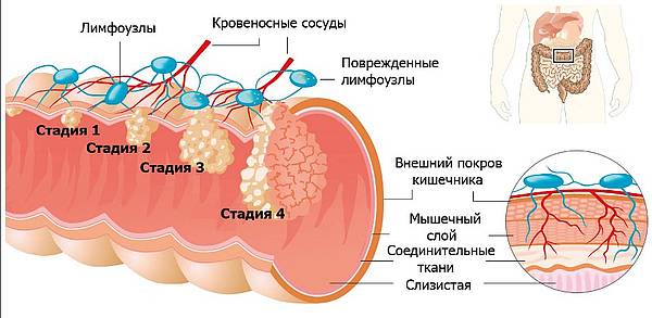 Стадии рака кишечника