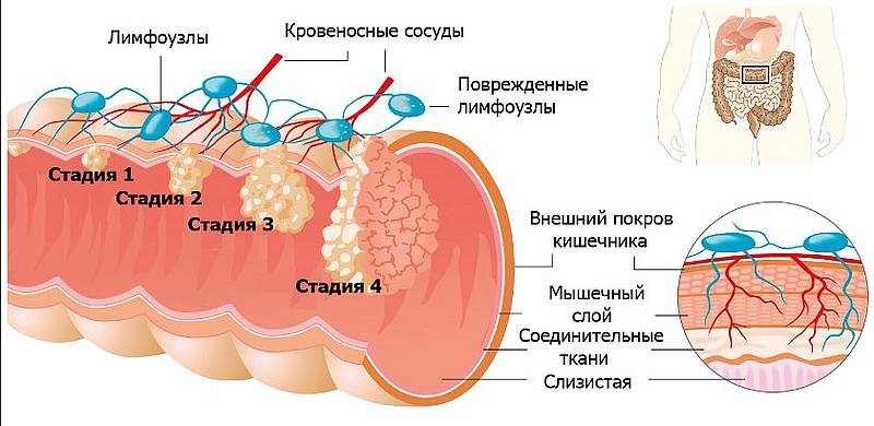 Можно вылечить 4 стадию рака. Классификация опухоли прямой кишки по стадиям. Стадии опухоли толстой кишки. Стадии опухоли прямой кишки. TNM толстой кишки классификация.