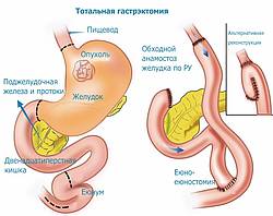 Тотальная гастрэктомия