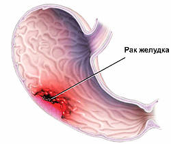 Рак желудка