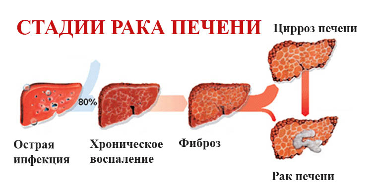 Рак печени 3 стадии